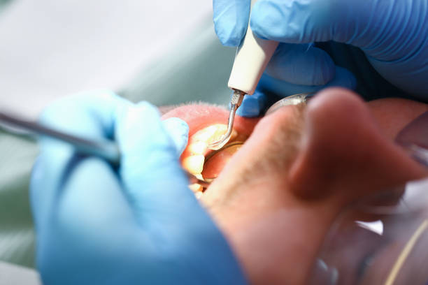 Best Emergency Dentist for Lost Fillings or Crowns in Greenfield, IA